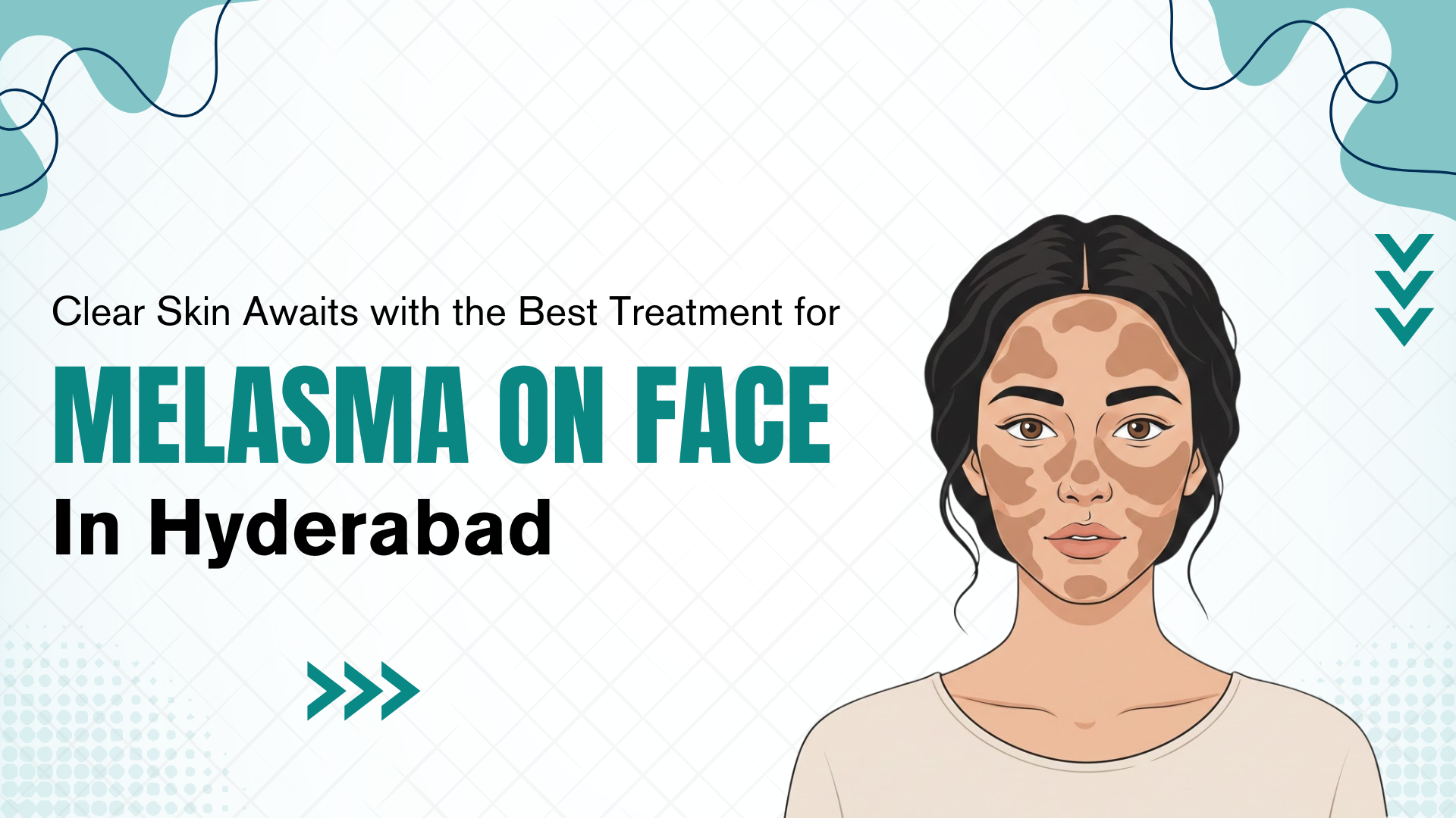 melasma on face